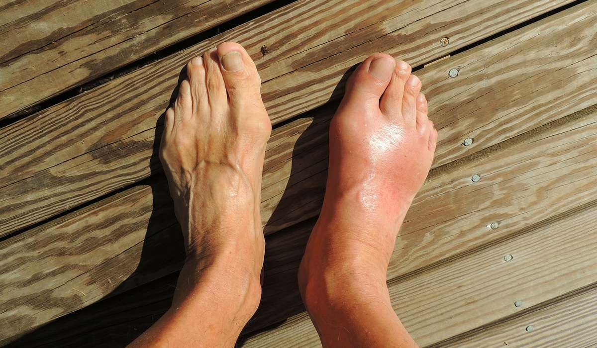 Bệnh Gout
